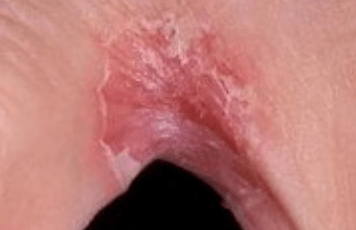 Beinpilz zwischen den Fingern