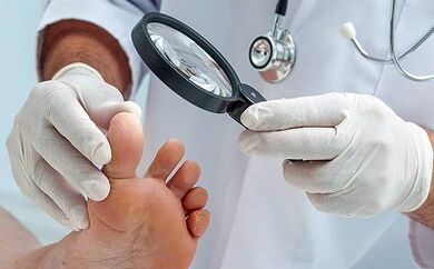 Wie Sie Ihren Nagelpilz loswerden