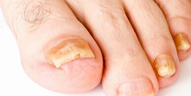 Wie und wie man Nagelpilz heilt
