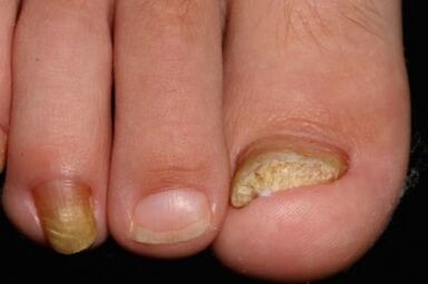 Beinnagel Mykose