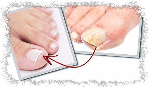 Ursachen für Nagelpilz